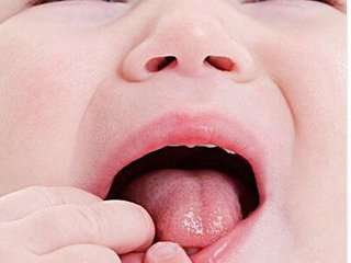 口腔溃疡怎么治疗 快速治疗口腔溃疡的偏方